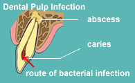 Dental pulp infection