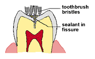 Fissure Sealant