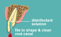 Cleaning and shaping the root canal with files