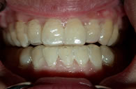 Bleaching tray seated onto teeth