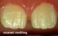 Tooth Mottling