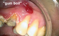 Sinus Tract