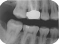 Bite-wing x-ray of right side